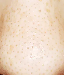 白いポツポツ毛穴