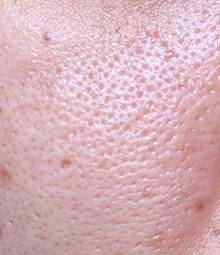 メイクで隠せない毛穴